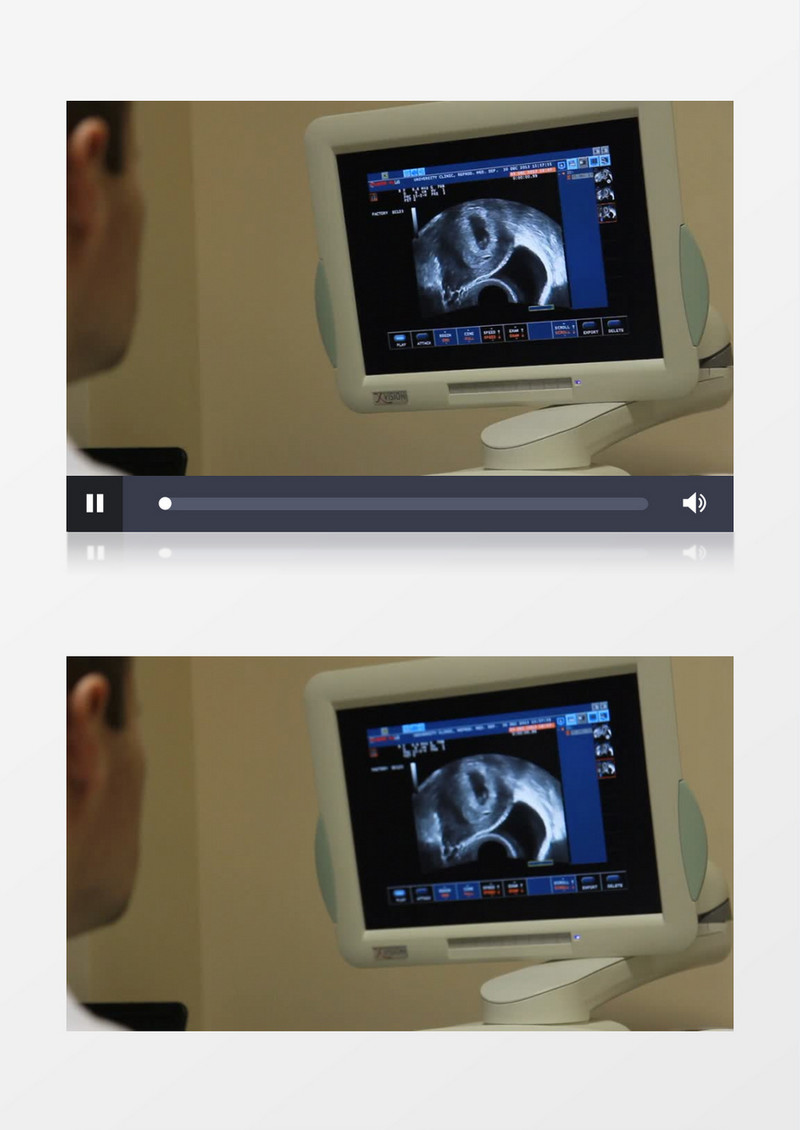 医生在给病人做多普勒彩超实拍视频素材