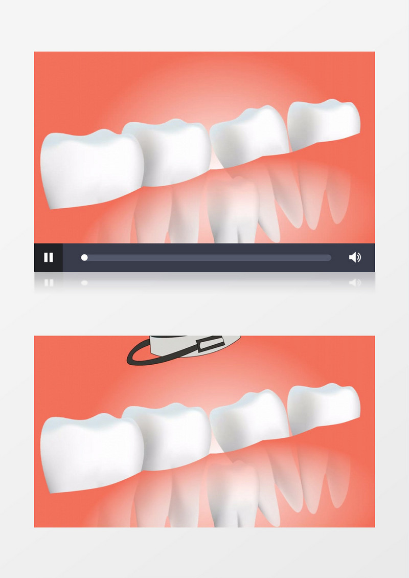 3D动画演示人类牙齿医疗手术牙科医生种牙视频素材