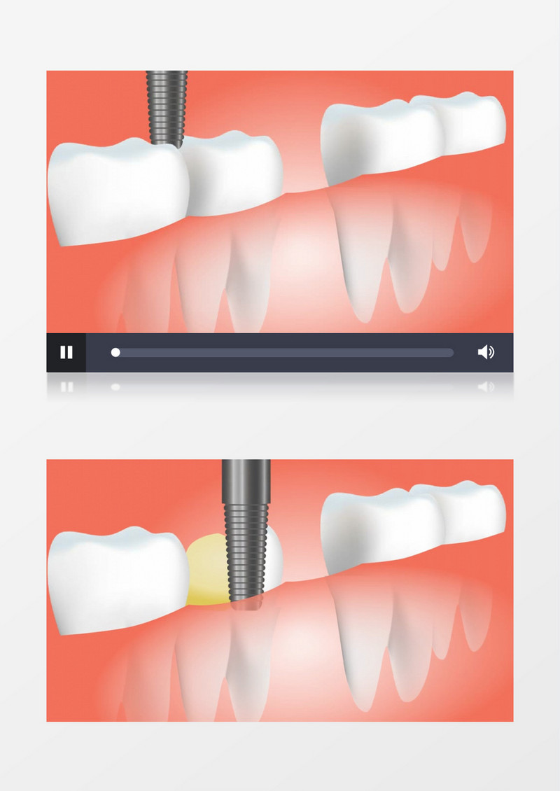 医疗牙齿补牙手术的3D模型视频素材
