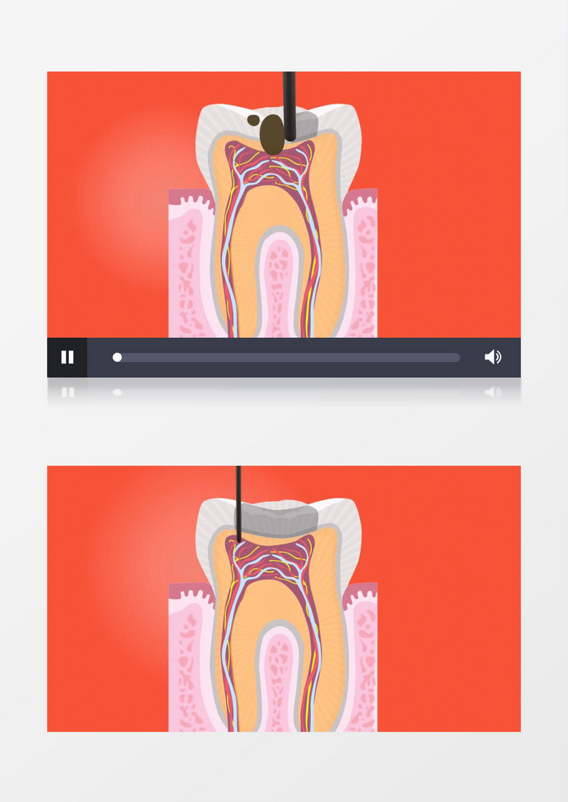 医院牙齿手术3d立体动画模型视频素材