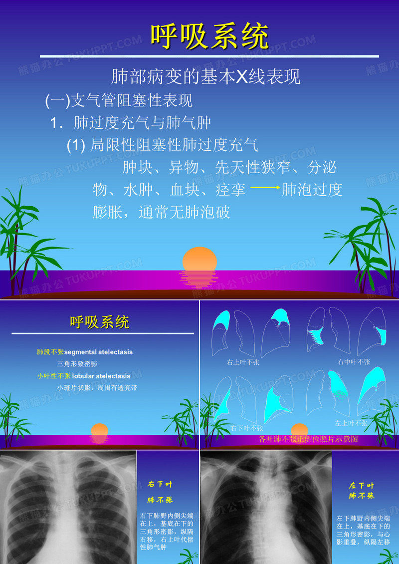 肺不张