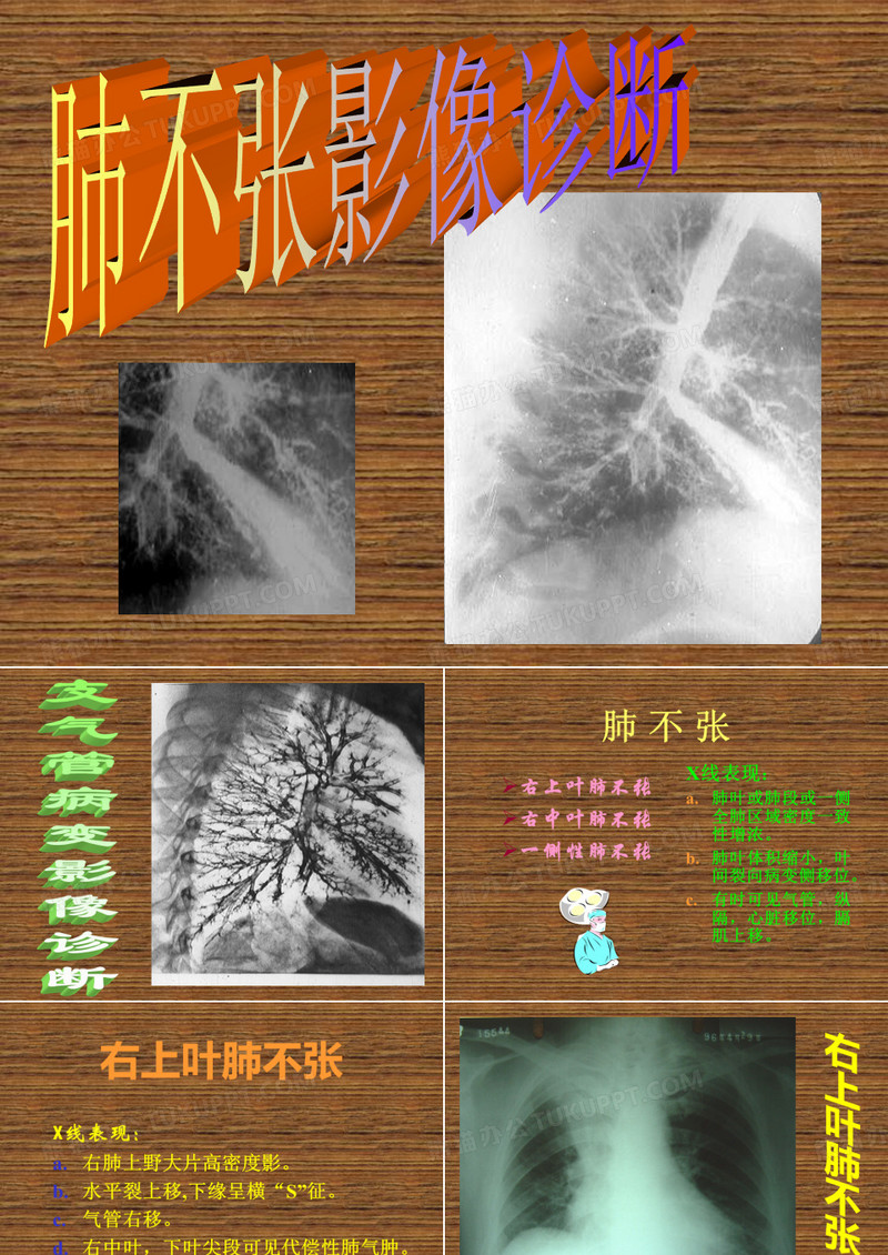 肺不张