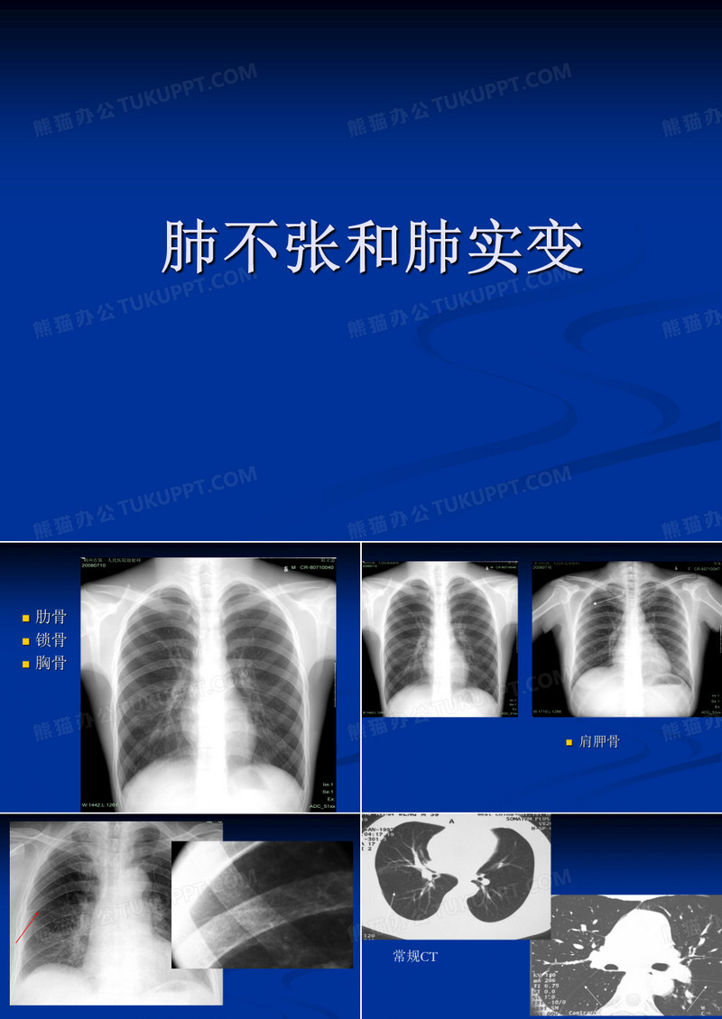 肺不张与肺实变