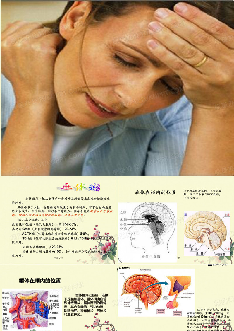 垂体瘤
