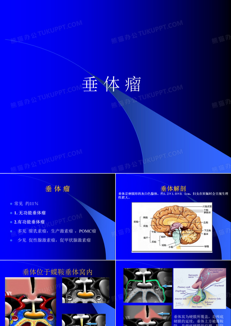垂体瘤介绍
