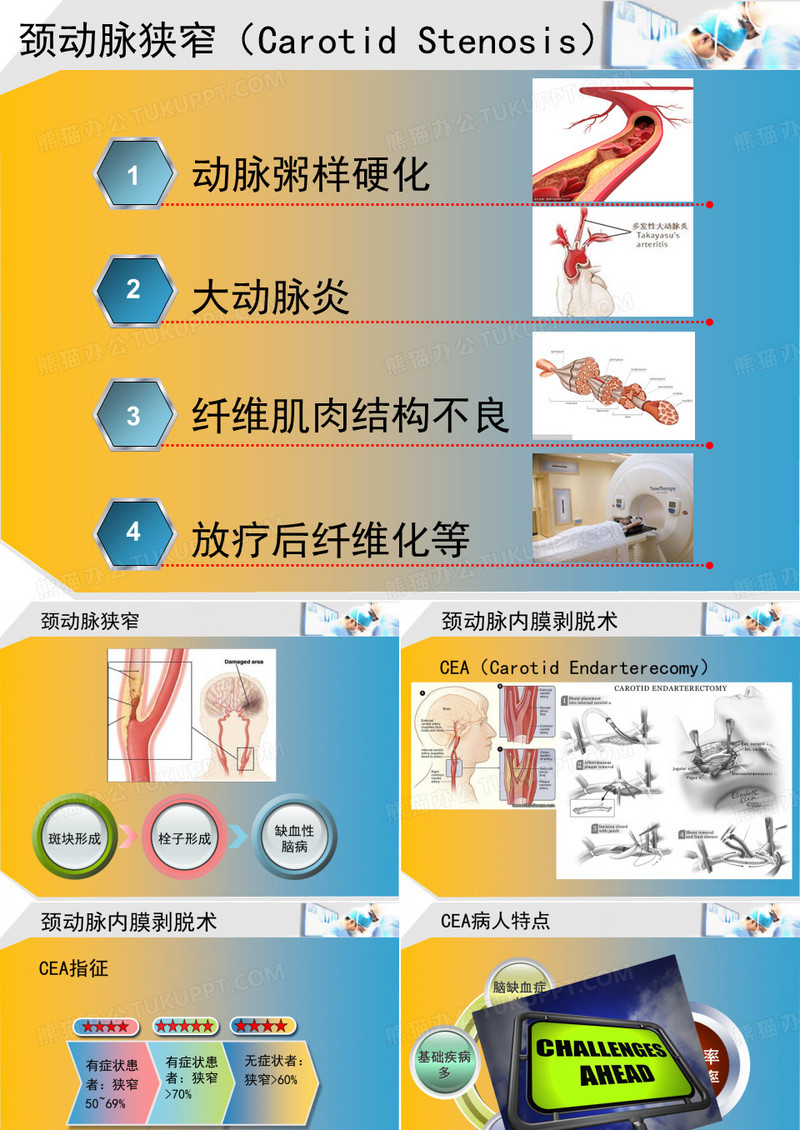 颈动脉内膜剥脱术麻醉