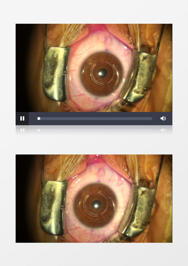 眼科病人眼球特写实拍视频素材
